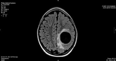 Case report of cerebral cystic echinococcosis in a 5-year-old child